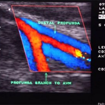 Color Doppler