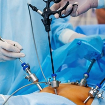 Laparoscopic Gastric Plication