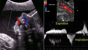 Sonography and colour doppler (प्रसुती आणि कलर डॉप्लर)