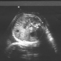 Sonography