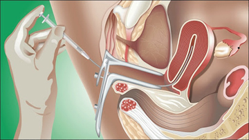 IUI(Intra Utreine Insemination) (शुक्रजंतू सोडणे)
