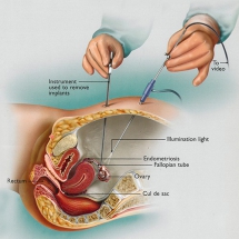 Performing laparoscopy